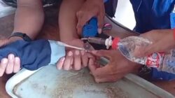 Jari bocah 9 tahun di Brebes membengkak setelah terjepit ring besi